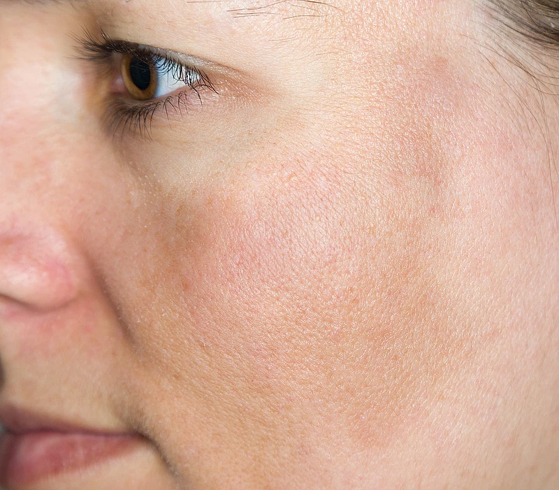 Junge Frau mit Pigmentflecken auf den Wangen